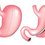 gastric sleeve