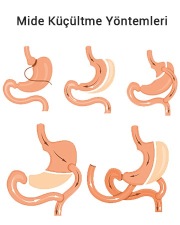 mide küçültme yöntemleri